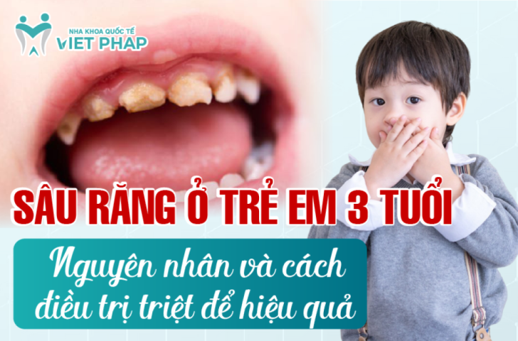 Sâu răng ở trẻ em 3 tuổi – Nguyên nhân và cách điều trị triệt để hiệu quả