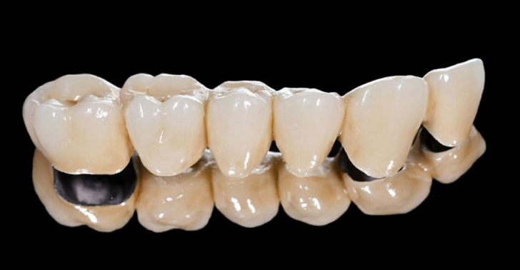 Nhổ răng bao lâu thì làm cầu răng? Giải đáp chi tiết từ chuyên gia