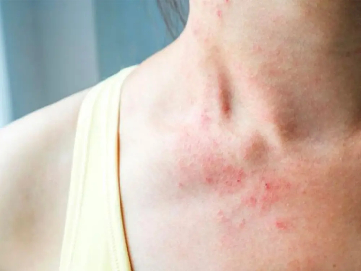 Viêm da cơ địa – Căn bệnh da liễu phổ biến không nên chủ quan