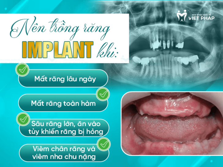 Khi nào nên trồng răng implant – 4 thời điểm “vàng” hiệu quả