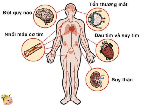 Biến chứng của bệnh tăng huyết áp
