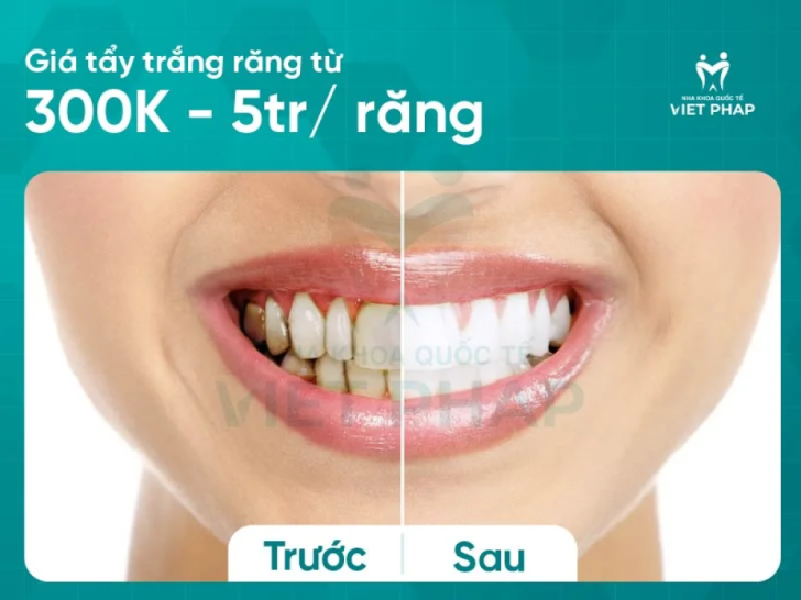Tẩy trắng răng giá từ 2.000.000 VNĐ