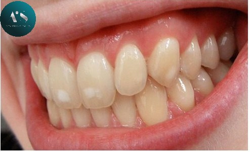Màu sắc răng và sức khỏe răng miệng