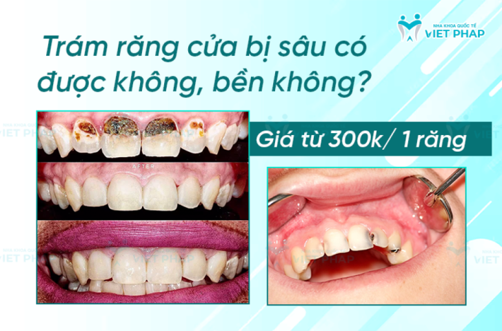 Trám răng cửa bị sâu có được không, bền không? Giá từ 300.000 VNĐ/ răng