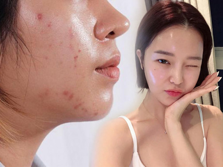 Giấy thấm dầu có làm tăng tiết bã nhờn như lời đồn?
