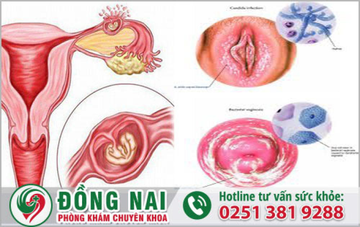 yếu tố gây chảy máu tử cung chớ xem thường