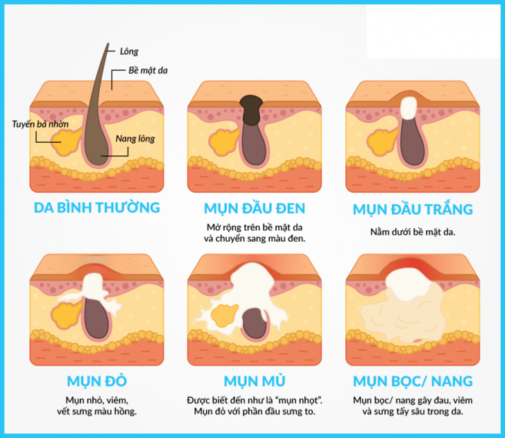 12 CÁCH TRỊ MỤN TRỨNG CÁ TẠI NHÀ