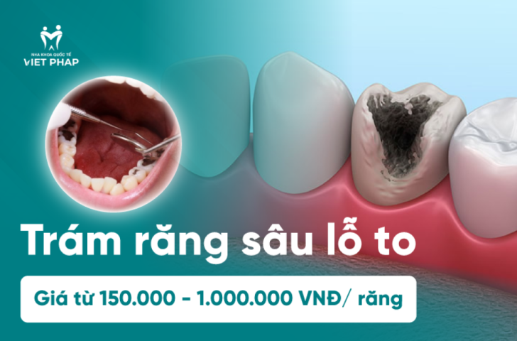 Trám răng sâu lỗ to bao nhiêu tiền? Từ 150.000 đến 1.000.000 VNĐ/răng