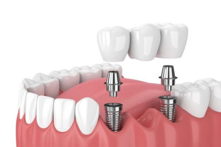 Cấy Ghép Implant Ở Đâu Tốt Nhất? Bí Quyết Chọn Địa Chỉ Uy Tín, An Toàn và Hiệu Quả