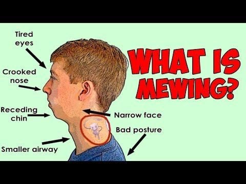 Phương pháp Mewing thay đổi khuôn mặt không cần phẫu thuật thẩm mỹ là gì?