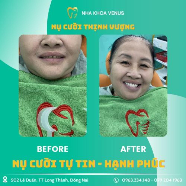 Chị Nguyễn Thu Hằng: “Tẩy trắng răng tại Nha khoa Venus giúp tôi tự tin hơn với nụ cười rạng rỡ”