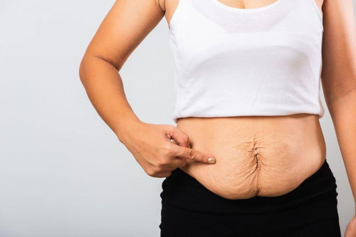 Da Bụng Chảy Xệ Sau Giảm Cân: Nguyên Nhân và Giải Pháp