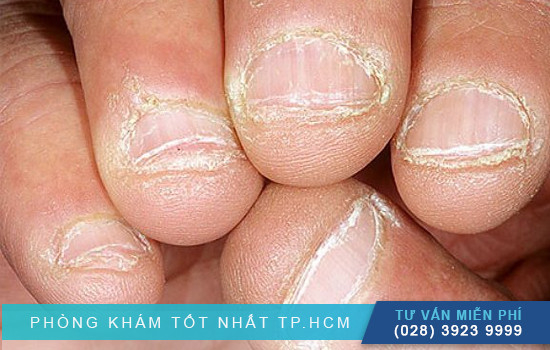 Nấm móng tay là gì ? Nguyên nhân gây nấm móng tay
