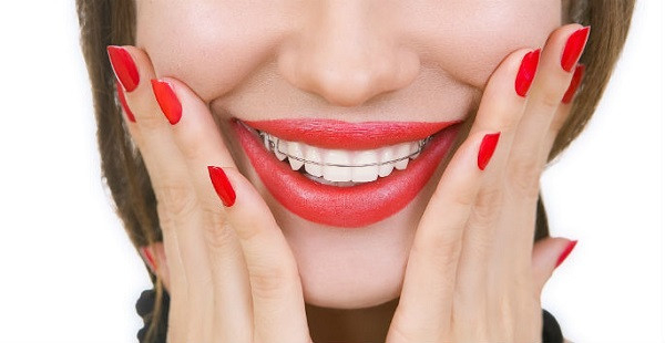 Niềng răng xong bị hô phải làm sao?