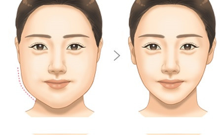 BÍ QUYẾT GIẢM MỠ MẶT – SỞ HỮU MẶT VLINE, KHÔNG LO TÁI PHÁT