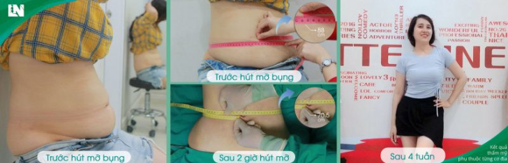 Quy trình hút mỡ bụng như thế nào?