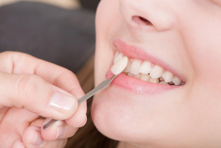 Dán Sứ Veneer Có Ăn Được Thịt Gà Không? Giải Đáp Chi Tiết Từ A-Z