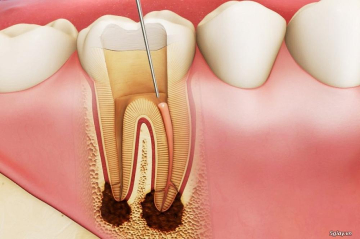 Đau Răng Sâu Có Phải Do Tủy? Khi Nào Cần Lấy Tủy Trước Khi Trám?
