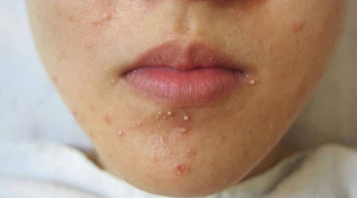 Cần cân nhắc những gì trước khi nặn mụn?